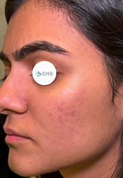 An image of the Client after undergoing Acne Treatment