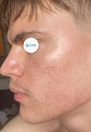 An image of the Client after undergoing Acne Treatment