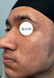 An image of the Client after undergoing Acne Treatment