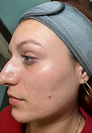 An image of the Client after undergoing Acne Treatment