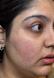 An image of the Client after undergoing Acne Treatment