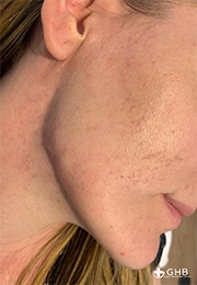 An image of the Client after undergoing Acne Treatment