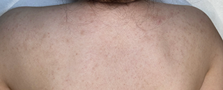 An image of the Client after undergoing Acne Treatment