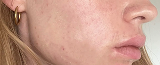 An image of the Client after undergoing Acne Treatment