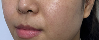 An image of the Client after undergoing Acne Treatment