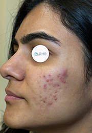 An image of the Client before undergoing Acne Treatment