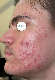 An image of the Client before undergoing Acne Treatment