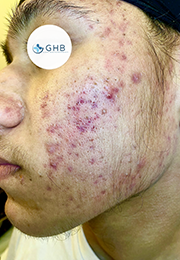 An image of the Client before undergoing Acne Treatment