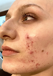 An image of the Client before undergoing Acne Treatment