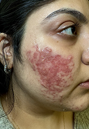 An image of the Client before undergoing Acne Treatment