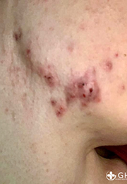 An image of the Client before undergoing Acne Treatment