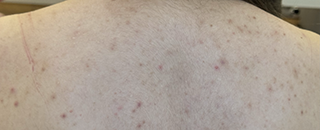 An image of the Client before undergoing Acne Treatment