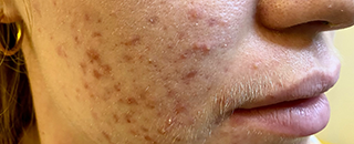 An image of the Client before undergoing Acne Treatment