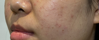 An image of the Client before undergoing Acne Treatment