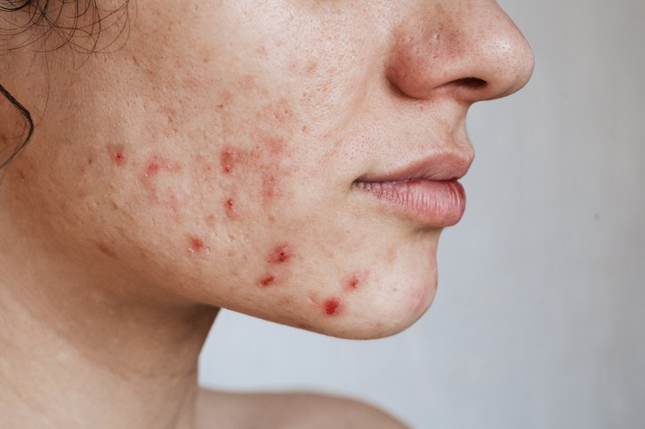 No filter photo of a face with Cystic acne problems