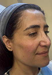 An image of the Client after undergoing Cheek Filler