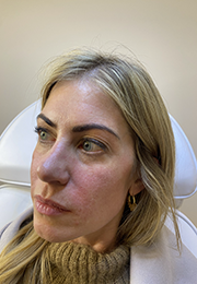 An image of the Client after undergoing Cheek Filler