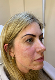 An image of the Client after undergoing Cheek Filler