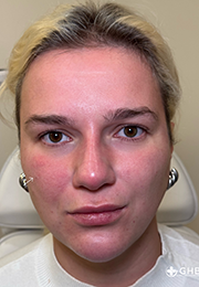 An image of the Client after undergoing Cheek Filler