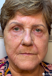 An image of the Client after undergoing Cheek Filler