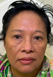 An image of the Client after undergoing Cheek Filler