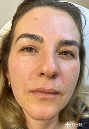 An image of the Client after undergoing Cheek Filler