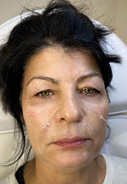 An image of the Client after undergoing Cheek Filler