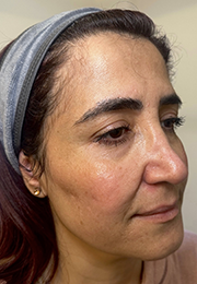 An image of the Client before undergoing Cheek Filler