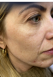 An image of the Client before undergoing Cheek Filler