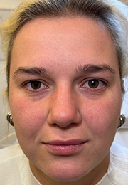 An image of the Client before undergoing Cheek Filler