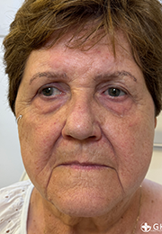 An image of the Client before undergoing Cheek Filler