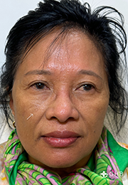 An image of the Client before undergoing Cheek Filler