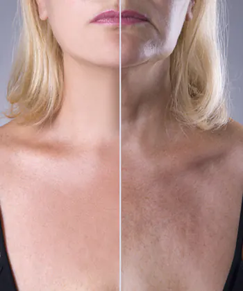 A photo representing Neck and Décolleté Rejuvenation before and after example