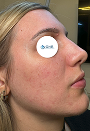 An image of the Client after undergoing Hyperpigmentation Treatment