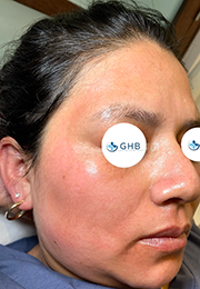 An image of the Client after undergoing Hyperpigmentation Treatment