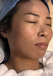 An image of the Client after undergoing Hyperpigmentation Treatment