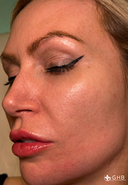 An image of the Client after undergoing Hyperpigmentation Treatment