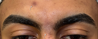 An image of the Client after undergoing Hyperpigmentation Treatment