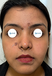 An image of the Client before undergoing Hyperpigmentation Treatment