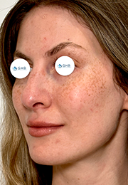 An image of the Client before undergoing Hyperpigmentation Treatment