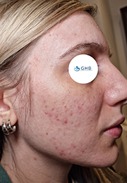 An image of the Client before undergoing Hyperpigmentation Treatment