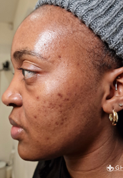 An image of the Client before undergoing Hyperpigmentation Treatment