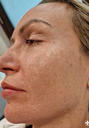 An image of the Client before undergoing Hyperpigmentation Treatment