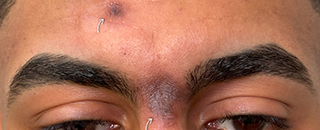 An image of the Client before undergoing Hyperpigmentation Treatment