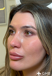 An image of the Client after undergoing Lip Filler