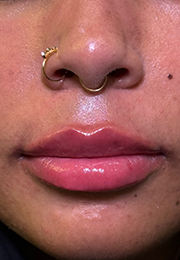 An image of the Client after undergoing Lip Filler