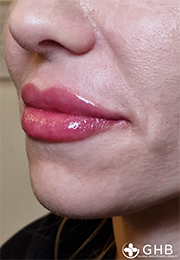 An image of the Client after undergoing Lip Filler