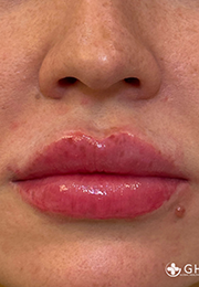 An image of the Client after undergoing Lip Filler