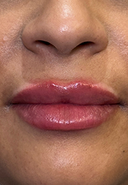 An image of the Client after undergoing Lip Filler