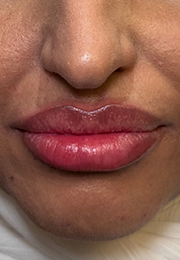 An image of the Client after undergoing Lip Filler